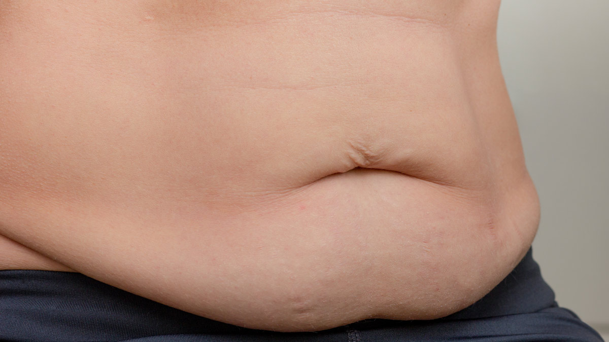 Viszerales Bauchfett Ein leicht adipöser Männerbauch